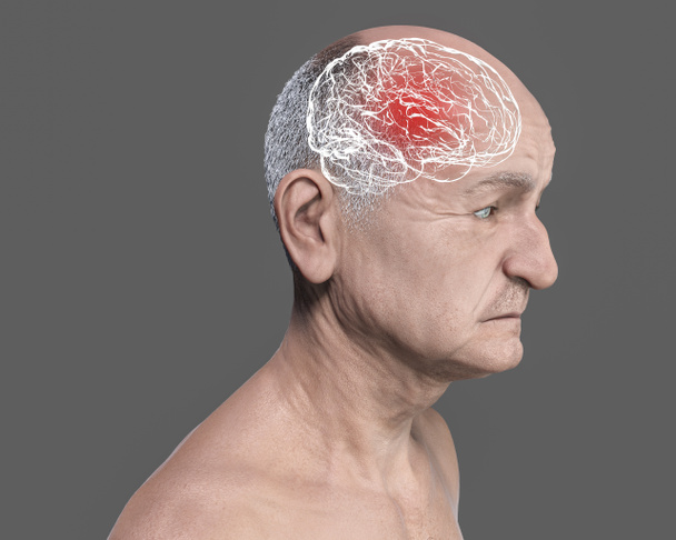 Bunama, kavramsal 3D çizim beyin fonksiyonlarında ilerleyen bozukluklar olan yaşlı bir insanı gösteriyor - Fotoğraf, Görsel