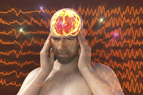 Päänsärky, migreeni, aivohalvaus, käsitteellinen 3D-kuva miehestä, jolla on pään kipua migreenin EEG-aaltojen taustalla - Valokuva, kuva