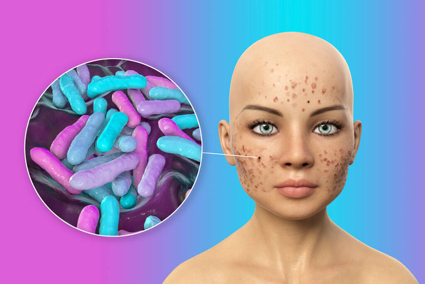Acné vulgaris sur la peau et vue rapprochée des bactéries Cutibacterium acnes, anciennement Propionibacterium acnes, associée au développement de l'acné, illustration 3D - Photo, image