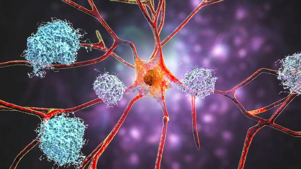 アルツハイマー病の神経細胞。脳組織内のアミロイド板、神経線維の角度や神経回路網の破壊を示す3Dイラスト - 写真・画像
