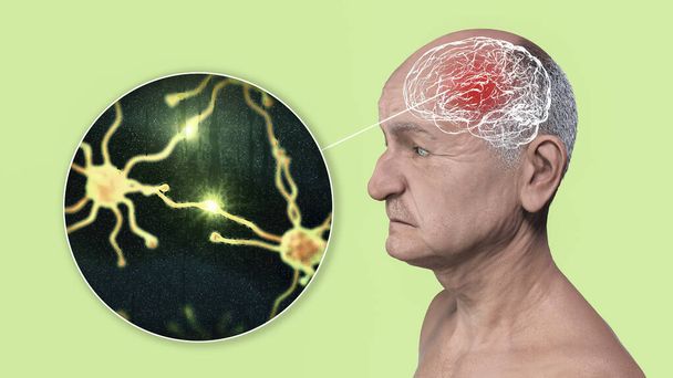Demencja, konceptualna ilustracja 3D pokazująca starszą osobę z postępującymi zaburzeniami czynności mózgu, niedrożnością neuronów i ich sieci - Zdjęcie, obraz