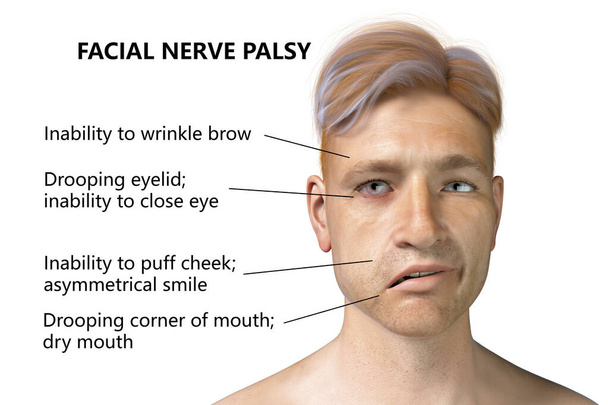 Παράλυση νεύρων προσώπου, παράλυση του Μπελ, τρισδιάστατη απεικόνιση που δείχνει αρσενικό με μονόπλευρη παράλυση νεύρων προσώπου - Φωτογραφία, εικόνα