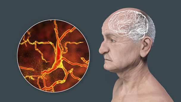 Dementia, conceptual 3D illustration showing an elderly person with progressive impairments of brain functions, distruction of neurons and their networks - Photo, Image