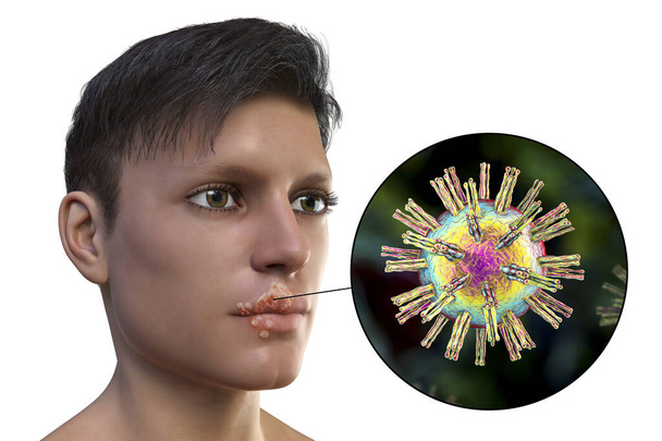 Herpes labial, también conocido como herpes labial, ilustración 3D que muestra lesiones en los labios del hombre causadas por el virus del herpes simple y vista de cerca del virus - Foto, imagen