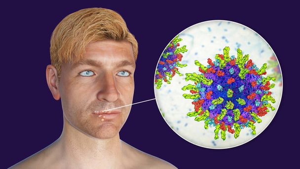 Herpes labialis, ook bekend als koortsblaasjes, 3D-illustratie met laesies op de lippen van de man veroorzaakt door herpes simplex virus en close-up zicht op het virus - Foto, afbeelding