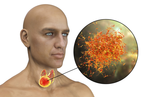 Karcinom štítné žlázy, 3D ilustrace zobrazující nádor uvnitř štítné žlázy a detailní pohled na nádorové buňky - Fotografie, Obrázek
