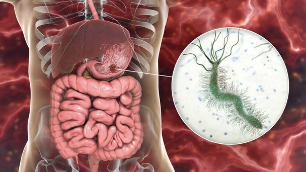 Ulcère de l'estomac et vue rapprochée de bactéries Helicobacter pylori, associées à la formation d'ulcères, illustration 3D - Photo, image