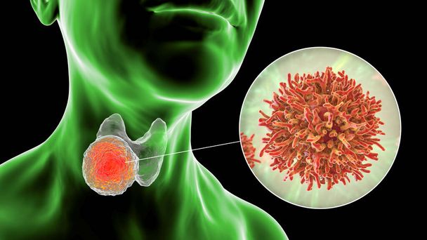 Рак щитовидної залози, 3D ілюстрація, що показує пухлину всередині щитовидної залози та крупним планом ракових клітин
 - Фото, зображення