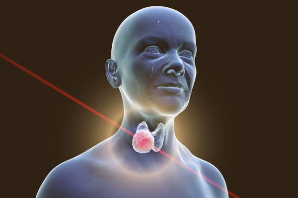 Cancer de la thyroïde chez la femme, illustration 3D montrant une tumeur à l'intérieur de la glande thyroïde. Concept de traitement du cancer de la thyroïde - Photo, image