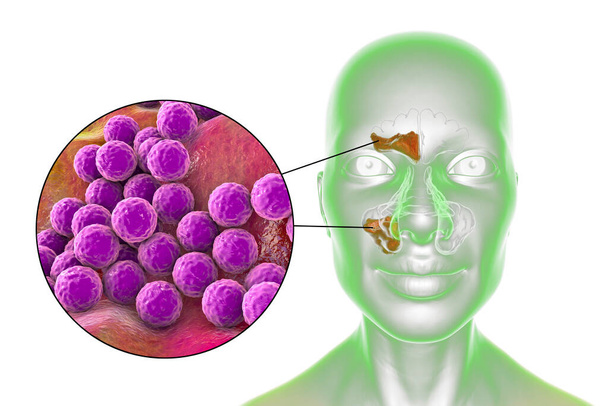 Sinusitis, inflammation of paranasal cavities. 3D illustration showing purulent inflammation of frontal and maxillary sinuses and close-up view of bacteria that cause sinusitis - Photo, Image