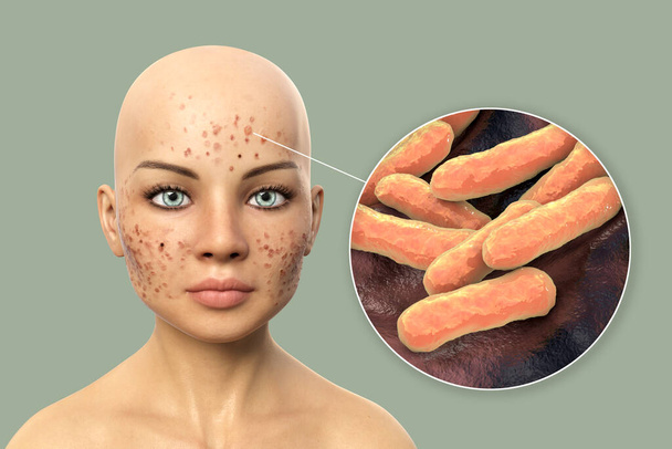Acne vulgaris on skin and closeup view of bacteria Cutibacterium acnes, formerly Propionibacterium acnes, associated with acne development, 3D illustration - Photo, Image