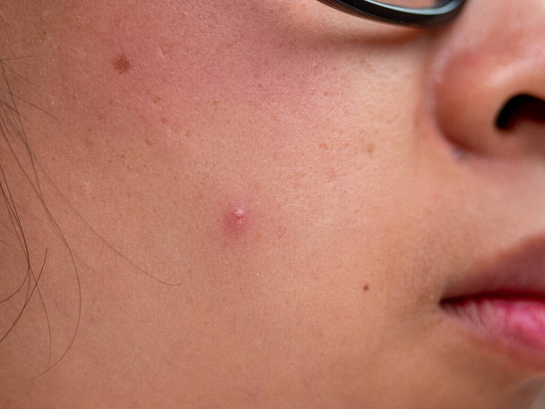 Close-up van acne op het gezicht van een jonge vrouw. Concept van probleemhuid op het vrouwelijke gezicht. - Foto, afbeelding