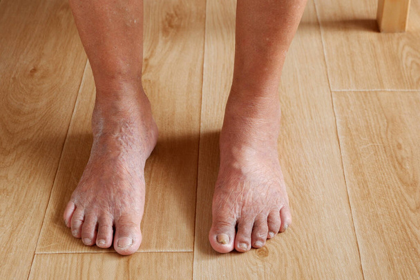 Фокус ноги, який є варикозним розширенням вен і зморшкуватою шкірою літньої азіатки, різні хвороби літніх людей і хороша концепція здоров'я
. - Фото, зображення