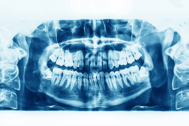 X-ray image of oral cavity with growing lower wisdom teeth on white background. - Photo, Image