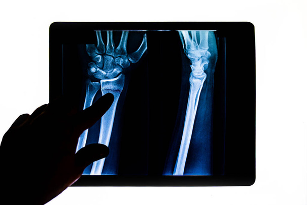 Médico que verifica a radiografia que examina a radiografia do braço do paciente apontando para a fratura do rádio. Uma mão humana com raio-X. Raios-X dos ossos da mão. Radiografia de tecnologia médica. - Foto, Imagem