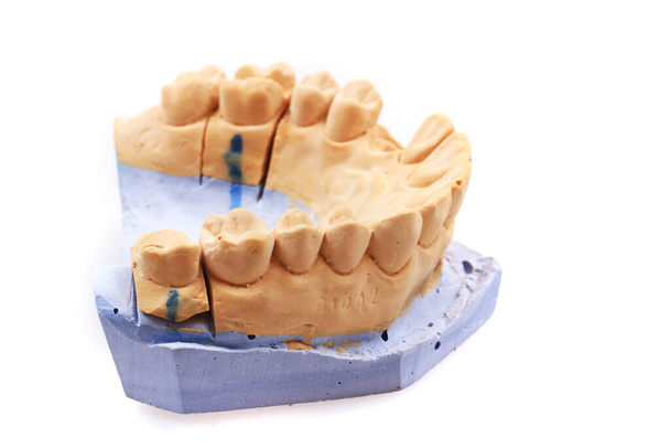 modelo de prótesis dental aislada sobre fondo blanco - Foto, imagen