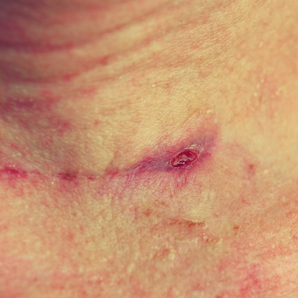 Cicatrice appena guarita sul collo dopo un intervento alla tiroide. - Foto, immagini