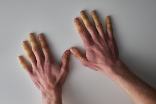 fehér ujjak a hideg, rossz vérkeringés - Fotó, kép