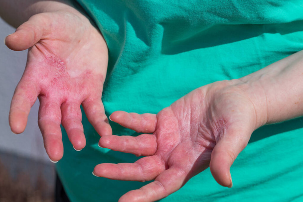 Атопический дерматит, женщина смотрит на красные и потрескавшиеся руки с серьезной аллергией  - Фото, изображение