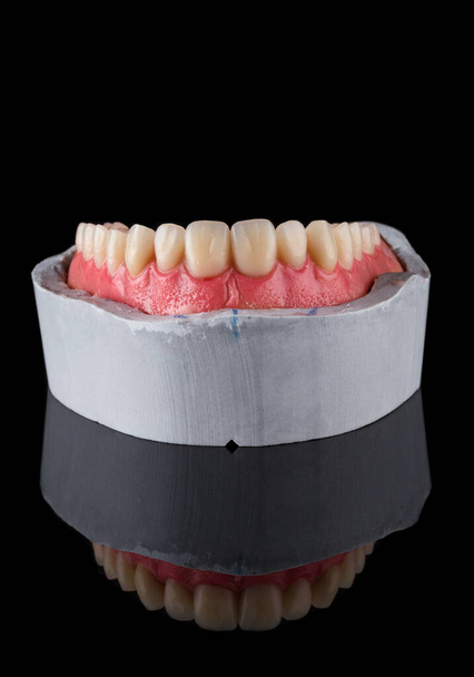 石膏モデルの上に逆さまに完全な上顎の入れ歯ワックスアップとジニバル反射と少しフロントビューで輪郭を描く。カラーA3 - 写真・画像