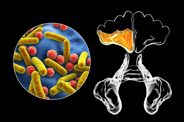 Sinuiitti, vainoharhaisten onteloiden tulehdus. 3D-kuva, jossa näkyy märkivä poskiontelotulehdus ja lähikuva poskiontelotulehdusta aiheuttavista bakteereista - Valokuva, kuva