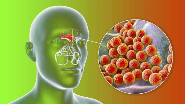 Sinusitis, Entzündung der Nasennebenhöhlen. 3D-Illustration mit eitriger Stirnhöhlenentzündung und Nahaufnahme des Bakteriums Staphylococcus aureus, das Sinusitis verursacht - Foto, Bild