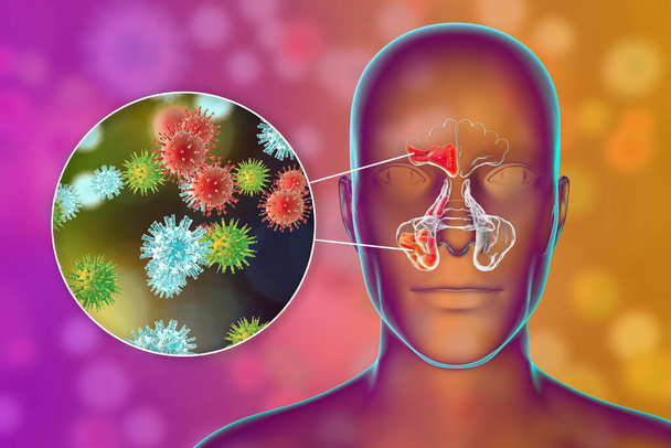 Viral sinusitis, inflammation of paranasal cavities. 3D illustration showing inflammation of frontal sinus and close-up view of viruses that cause sinusitis - Photo, Image