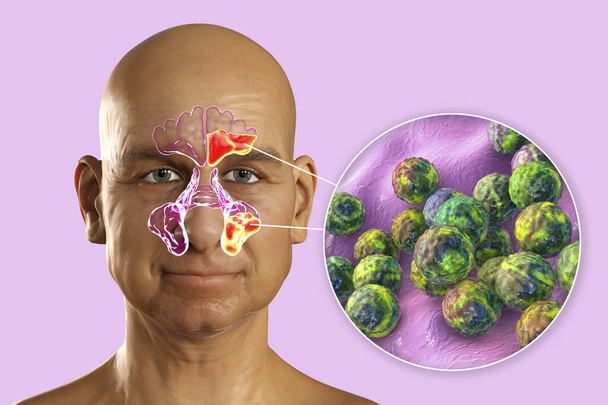 Sinusitis, inflammation of paranasal cavities. 3D illustration showing purulent inflammation of left frontal and maxillary sinuses and close-up view of bacteria Staphylococcus aureus - Photo, Image
