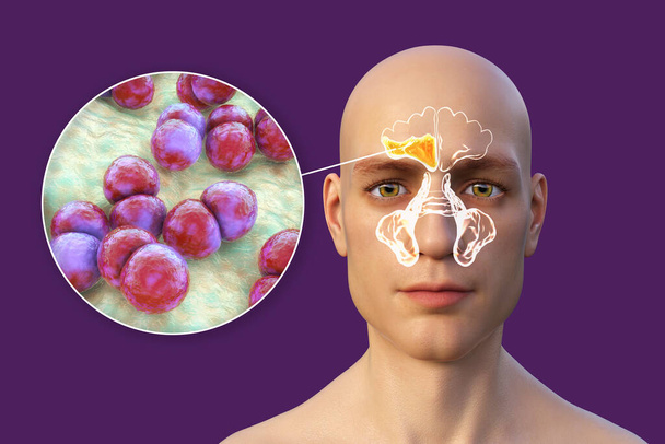 Παραρρινοκολπίτιδα, φλεγμονή των παραρρινικών κοιλοτήτων. 3D απεικόνιση που δείχνει πυώδη φλεγμονή του δεξιού μετωπιαίου κόλπου σε ένα άτομο και κοντινή προβολή των βακτηρίων Streptococcus pneumoniae που προκαλούν ιγμορίτιδα - Φωτογραφία, εικόνα