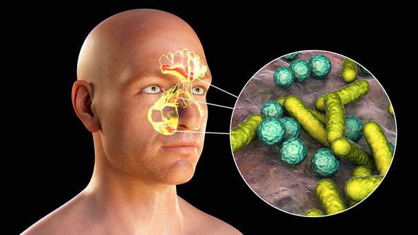 Sinusitis, inflammation of paranasal cavities. 3D illustration showing purulent inflammation of frontal, maxillary, and ethmoid sinuses in a man and close-up view of bacteria that cause sinusitis - Photo, Image
