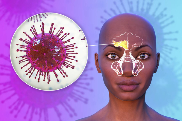 Παραρρινοκολπίτιδα, φλεγμονή των παραρρινικών κοιλοτήτων. 3D απεικόνιση που δείχνει πυώδη φλεγμονή του δεξιού μετωπιαίου κόλπου σε ένα πρόσωπο και κοντινή προβολή των ιών που προκαλούν ιγμορίτιδα - Φωτογραφία, εικόνα