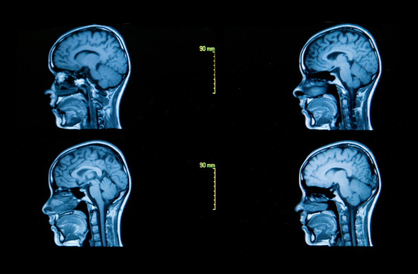 beyin bilgisayarlı tomografi görüntüleri bir dizi - Fotoğraf, Görsel