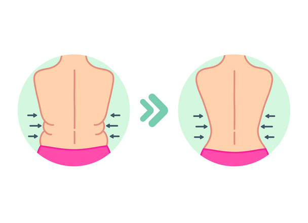 Dikke rug. Dikke plooien aan de zijkanten van vrouwen. Voor en na dieet, fitness of liposuctie. - Vector, afbeelding