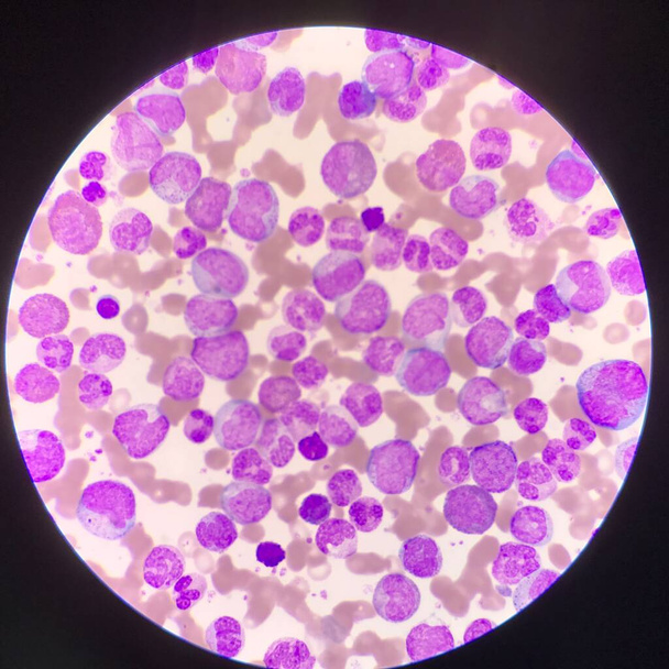 Blutbild von Leukämie unter dem Mikroskop gefunden. - Foto, Bild