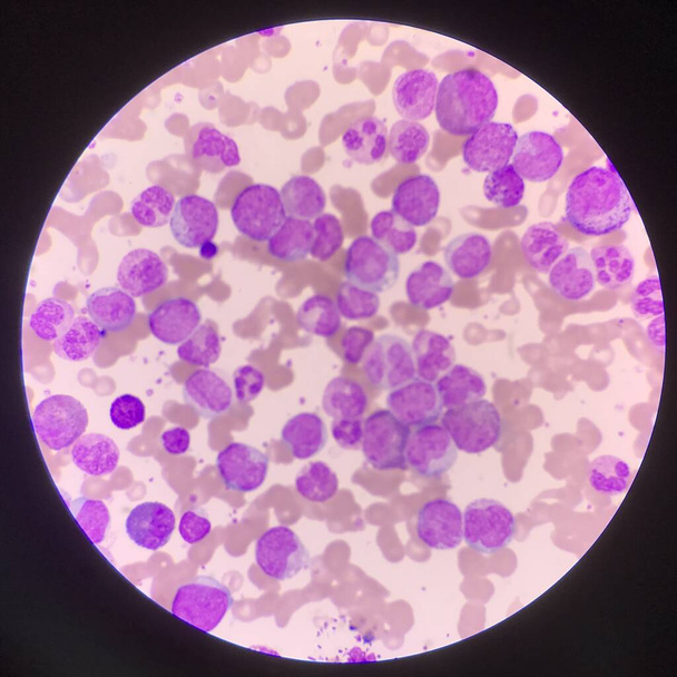 Знайти кров'яний малюнок лейкемії з мікроскопом
. - Фото, зображення