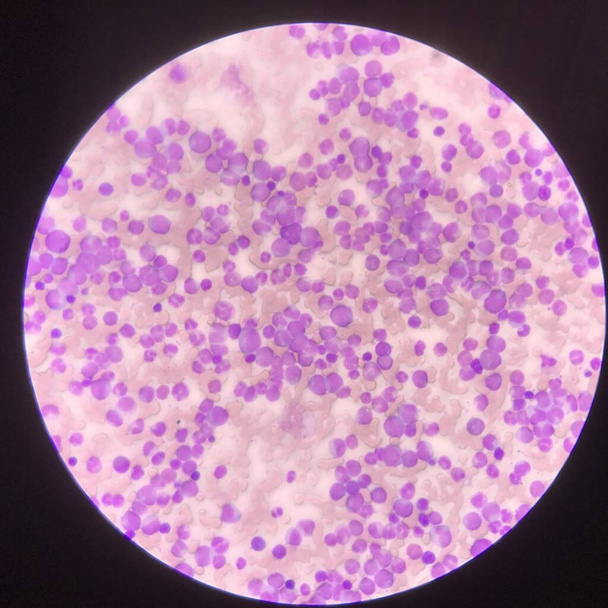 顕微鏡で見つける白血病の血液画像. - 写真・画像