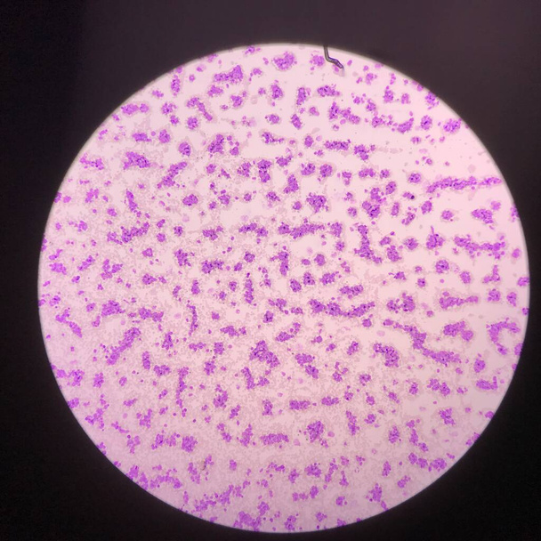 Blutbild von Leukämie unter dem Mikroskop 100X. - Foto, Bild