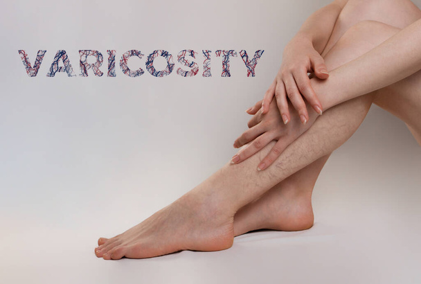 Medicine and health. The concept of female varicose veins. The woman crossed her arms over her legs, which were covered with veins and spider veins. Text VARICOSITY. Copy space. - Photo, Image