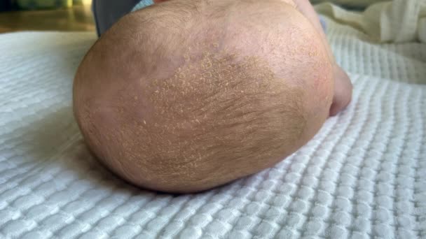 аллергия или сыпь на голову и лоб новорожденного ребенка - Кадры, видео