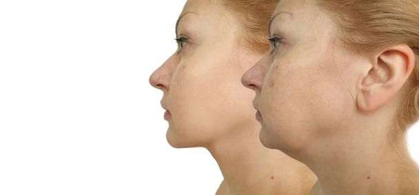 woman double chin before and after treatment - Photo, Image
