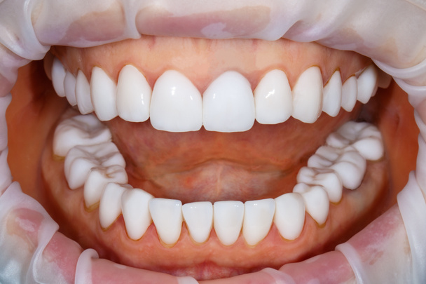 Tand van de tanden na de behandeling. Foto van de tanden dicht. Tanden bleken beeld. Behandelplan voor nieuwe glimlach. Ik maak bleekmiddel fineer. Tandheelkundige fotografie. - Foto, afbeelding