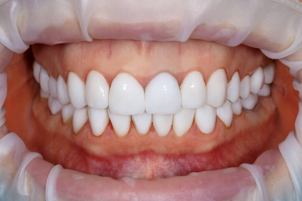 Stomatologia zębów po leczeniu. Zdjęcie zębów z bliska. Obraz wybielania zębów. Plan leczenia nowego uśmiechu. Robię forniry wybielające. Fotografia dentystyczna. - Zdjęcie, obraz