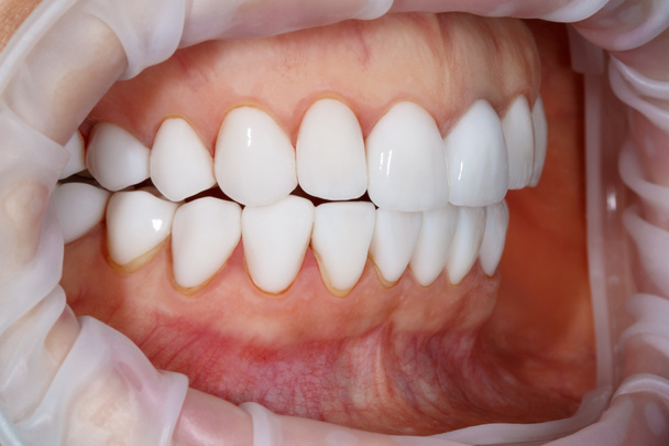 Dental of teeth close up. Teeth whitening image. Bleach veneers. Dental photography. - Foto, imagen