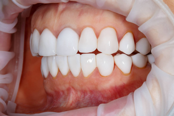 Dentale dei denti vicino. Sbiancamento dei denti immagine. Impiallacciature di candeggina. Fotografia dentale. - Foto, immagini
