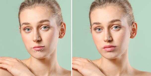 Beautiful young woman before and after lips enhancement on color background - Photo, Image