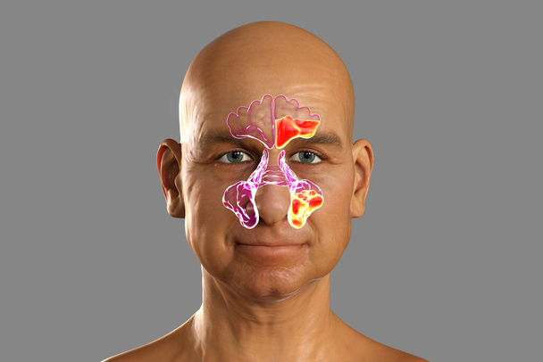 Sinusitis, ontsteking van paranasale holtes. 3D illustratie toont purulente ontsteking van frontale en maxillaire sinussen bij een man - Foto, afbeelding
