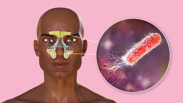 Bactéries Pseudomonas aeruginosa comme cause de sinusite. Illustration 3D montrant une inflammation purulente des sinus frontaux chez un homme africain et une vue rapprochée des bactéries pus bleu-vert - Photo, image
