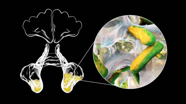 Bactéries Pseudomonas aeruginosa comme cause de sinusite. Illustration 3D montrant l'inflammation des sinus maxillaires et vue rapprochée de la bactérie Pseudomonas - Photo, image
