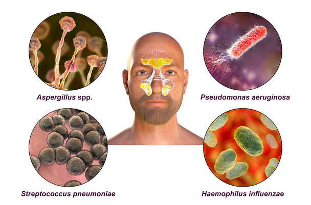 Orrmelléküreggyulladást okozó rhinosinusitis és mikroorganizmusok, Aspergillus gombák, Pseudomonas aeruginosa baktériumok, Streptococcus pneumoniae és Haemophilus influenzae, címkézett 3D illusztráció - Fotó, kép