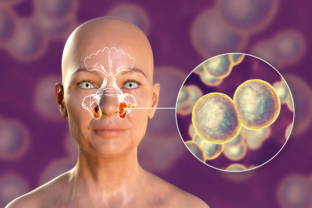 Τα βακτήρια Moraxella catarrhalis ως αιτία ιγμορίτιδας. 3D απεικόνιση που δείχνει φλεγμονή των άνω γνάθων κόλπων και κοντινή προβολή των βακτηρίων Moraxella - Φωτογραφία, εικόνα
